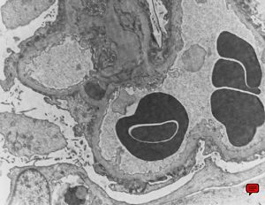 F,70y. | nephrotic syndrome: minimal changes - fusion of pedicles